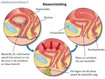 Blaasontsteking e. coli illustratie