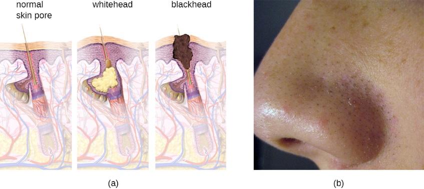 Blackheads