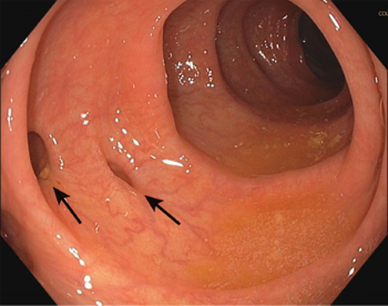 Diverticulitis Medicijn.nl