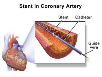 Stent - medicijnen24.nl