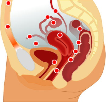 Endometriose - medicijnen24.nl