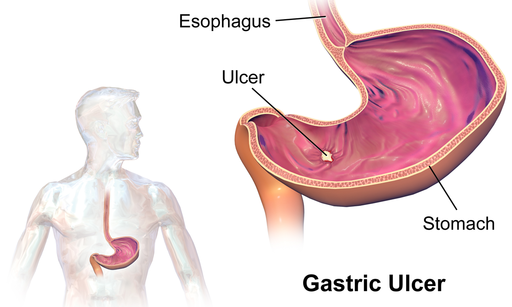 Gastric Ulcer - medicijnen24.nl