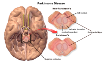 Hersenen Parkinson