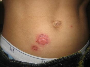 Impetigo met crustosa