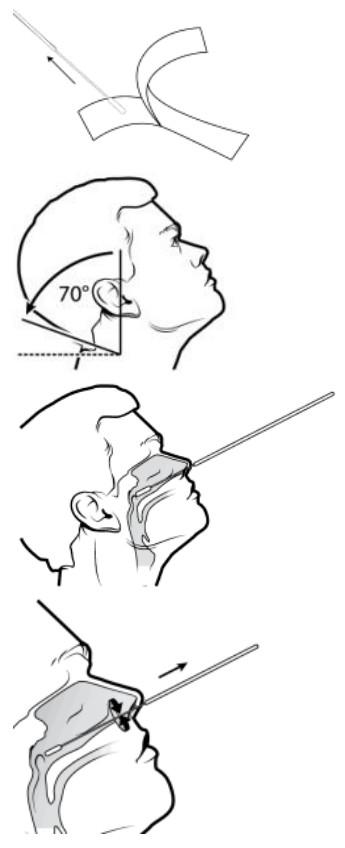 Lungene nasofaryngeale swab