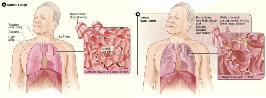 Vergelijking longen met en zonder COPD