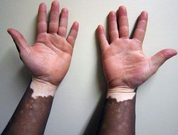 Vitiligo