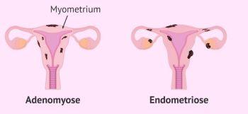 Adenomyose - medicijnen24.nl