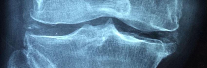 Het verschil tussen artrose en artritis – twee reumatische aandoeningen