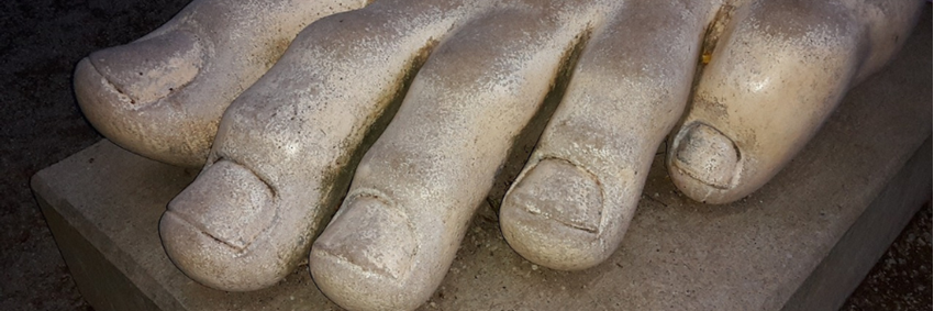 Een hallux valgus; scheefstand van de grote teen