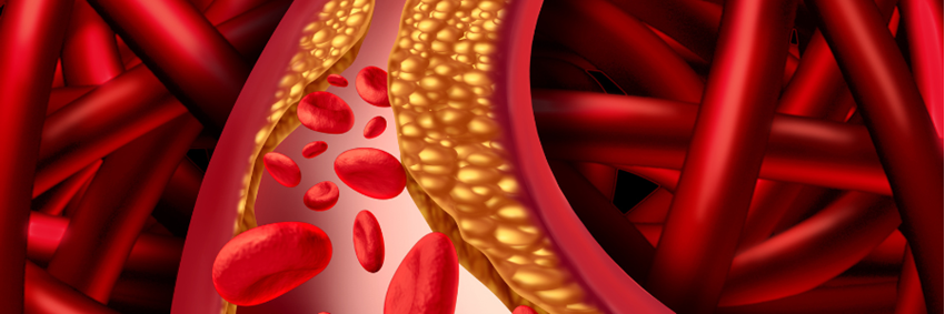 Familiaire hypercholesterolemie (FH)