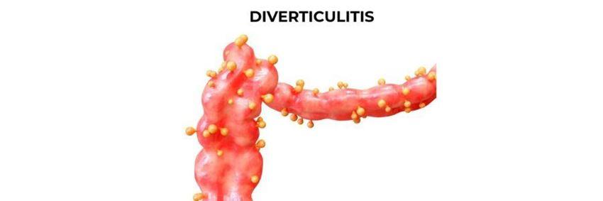 Diverticulitis